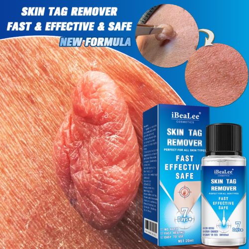 ibea-lee-skin-tag-remover