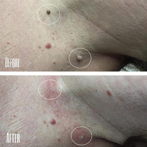 ibea-lee-skin-tag-remover